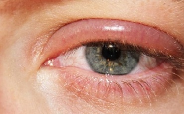 Блефариты – группа заболеваний, которые характеризуются воспалением век с поражением их наружных краев.